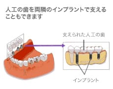 インプラントイメージ