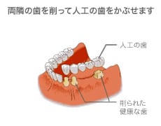 入れ歯イメージ