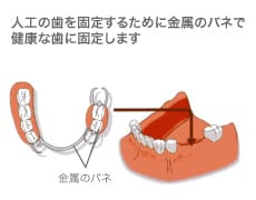 入れ歯イメージ