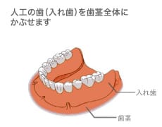 入れ歯イメージ